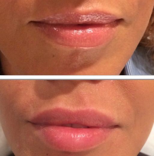 Juvederm Lips Enhancement