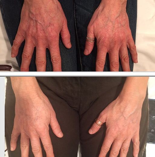 Radiesse Hands Injections for Volume